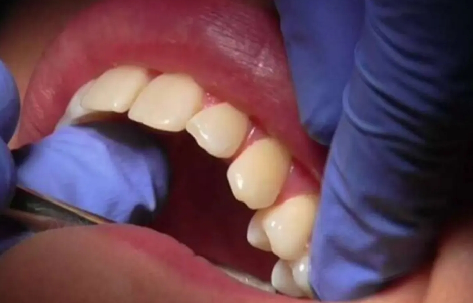 سن اليأس والأسنان 